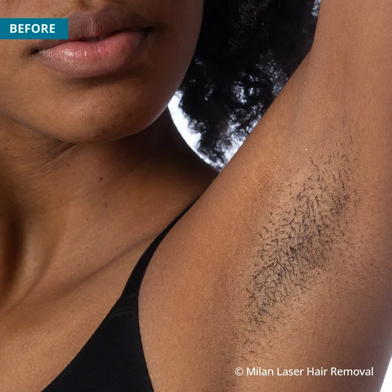 Benefits of Underarm Hair Removal Laser Bar  Spa Laser Hair Removal