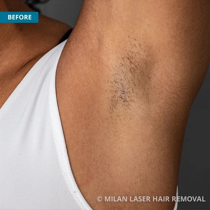 Laser Hair Removal in Milwaukee  EvolvMD