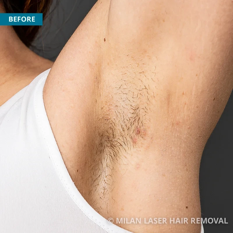 Armpit Laser Hair Removal Cost Information and Everything Else  Indy  Laser